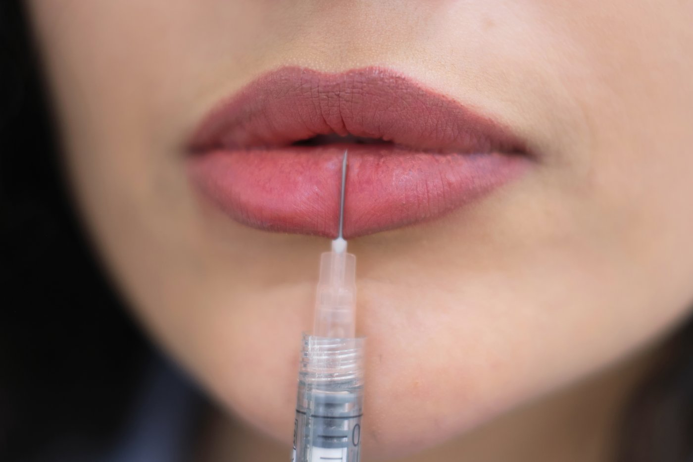 Liplift - Op. Dr. Emre Yilmazer Yilmazer Clinic